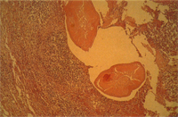 圖8： 肺局部壞死灶，可見蟲體切面及大量炎症細胞圍繞。