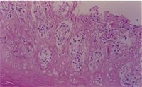 圖4：蹄冠部上皮組織切片可見上皮細胞增生,壞死及氣球樣變性,炎症細胞聚集於病灶區內。