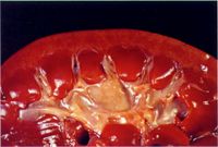 圖3：腎雙側皮質部密發針點狀出血點