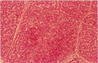 圖4：肝臟呈多發局部出血壞死灶，其周圍及肝竇狀隙有網狀內皮細胞及淋巴球聚集。