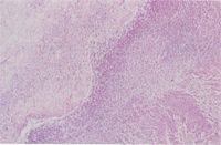 圖2：病灶區外圍可見大量Fibroblasts增生。