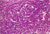 圖3：肺泡腔中充滿了呈漩渦狀排列之單核炎症細胞。H&E stain