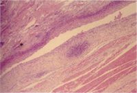 圖3：關節滑膜下層結締組織可見小的化膿病灶，滑膜層慢性炎症反應。