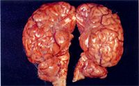 圖1：大小腦,腦幹表面呈現瀰漫性白色混濁，腦迴較不明顯。 
