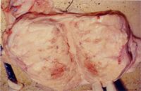 圖2：乳房有7.45公斤重，兩分房乳腺皆有硬腫的區域，局部乳房組織有潮紅出血的現象。