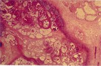 圖3：乳腺有大區域性化膿灶，尤其周圍大量肉芽組織增生的病變，該病灶區及結締組織周圍可見大量巨噬細胞及嗜中性球浸潤。