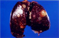 圖2：肝臟腫大，並明顯可見灰白色結節侵入實質中。