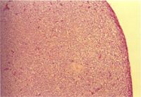 圖3：胰臟低倍可見大量腫瘤細胞浸潤。
