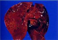 圖1：肝臟腫大，密發大小不一圓形凹陷病灶。