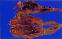 圖2：盲腸腫大出血，腸壁肥厚並有深層潰瘍。
