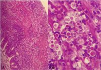 圖3A：盲腸病變深入粘膜層、粘膜下層、肌層。圖3B：粘膜層腺體部周圍可見到大量的組織鞭毛蟲蟲體。