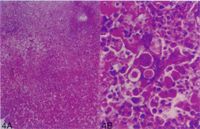 圖4A：肝臟多發大區域壞死病灶。圖4B：肝臟病灶區可見大量各時期組織鞭毛蟲蟲體。
