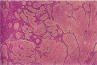 圖3：團塊含豐富的纖維基質，許多索狀和島狀的鱗狀上皮細胞群呈不規則地侵入整個增生的纖維結締組織基質