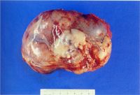 圖1：左腎腫瘤外有被膜覆蓋，呈橢圓形外觀，表面有不規則突起，觸感堅實。重 653 克，大小為 13.5 × 10 × 8.5 立方公分。