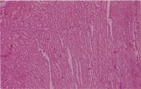 圖3：腫瘤細胞排列成多層立方或柱狀上皮，且突出成多分枝乳突狀 (papillae) 構造。