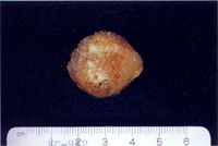 圖1：檢體團塊物呈圓頂型，頂上有一潰瘍灶。