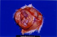 圖2：腫瘤呈橢圓，直徑約5公分，內有許多肉色小結節，並包以灰白色較硬之結締組織，不易切開 。