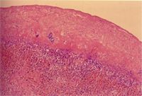 圖3：脾組織切片： 脾臟漿膜面增厚，附著粉紅色膜樣之纖維素性滲出液。