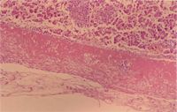 圖4：肝組織切片： 肝被膜增厚，實質中有多發局部凝固樣壞死灶。