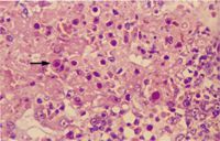 圖4：肝細胞內有嗜鹼性核內包涵體。(箭頭所指) (H & E stain, 400X)