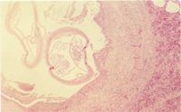 圖3：肺臟水腫、鬱血，肺動脈管腔內可見太心絲蟲之成蟲蟲體，肺動脈內皮細胞脫落，肺動脈中層增生，其管腔擴大形成血管瘤(Aneurysm)。