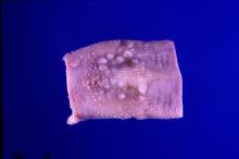 圖2：舌頭之水泡病變。