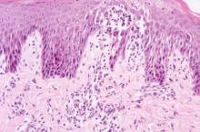 圖3：切片下舌頭上皮細胞水腫變性，有些區域可見淺層之小潰瘍灶。 