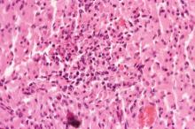 圖4：切片下心肌細胞呈岑克氏壞死，局部心肌細胞橫紋消失、肌細胞質顆粒化及肌細胞核濃縮及破裂等變化。