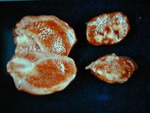 圖1：扁桃腺潮紅，下頜淋巴結可見明顯大區域壞死灶。