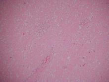 圖2：大腦可見單核細胞圍管現象及神經膠質細胞過多等病變。H&E stain, 200×。