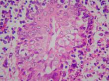 圖3：扁桃腺壞死區周圍腺窩上皮可見嗜酸性核內包涵體。H&E stain, 400×。