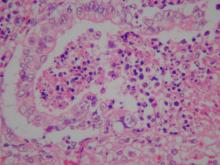 圖4：肺臟壞死灶周圍小支氣管上皮細胞可見嗜酸性核內包涵體。H&E stain, 400×。