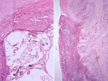 圖4A：舌上皮細胞水腫變性，由壞死及脫落之上皮細胞、細菌團塊形成空腔。4B：舌潰瘍灶含大量壞死細胞碎片，棘細胞死亡形成壞死區，部份基底細胞增生，肌肉層之橫紋肌變性、壞死。