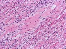 圖6：心肌纖維斷裂、肌纖維與肌纖維間有大量炎症細胞浸潤及壞死細胞碎片。