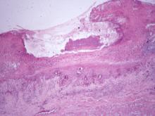 圖7：仔牛舌局部上皮細胞水腫變性、壞死脫落，滲出液聚集形成小水泡，有些水泡破裂已形成潰瘍灶，複層扁平上皮消失，由大量壞死細胞、細菌團塊及炎症細胞所取代。 