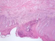 圖8：仔牛舌潰瘍處鱗狀上皮細胞壞死、大量壞死細胞碎片蓄積及炎症細胞浸潤，上皮組織之基底細胞增生、形成皮釘深入基底層，肌肉層橫紋肌變性、壞死。 