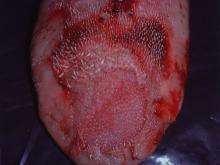 圖6：口蹄疫病牛舌頭水泡破裂，上皮剝離。