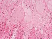 圖7：趾間上皮：上皮細胞水腫變性、大量粉紅色滲出液聚集形成空腔。X40 