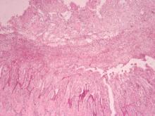 圖8：蹄冠上皮：小水泡匯集成大水泡，致表層細胞與基底層細胞剝離，形成明顯空腔，此空腔內含水泡液及壞死脫落之上皮細胞。X40