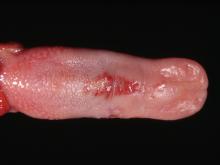 圖2：舌頭中段黏膜面有淺層紅色糜爛灶。