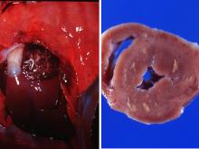 圖3A.：心耳有白色壞死灶。圖3B.：心肌切面可見黃白色壞死灶。 