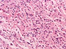 圖4：切片下心肌細胞呈岑克氏壞死，局部心肌細胞橫紋消失、肌細胞質顆粒化及肌細胞核濃縮及破裂等變化。