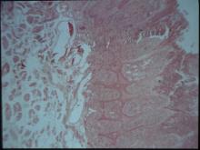 圖2：口唇部皮膚切片下可見表皮棘細胞增生。