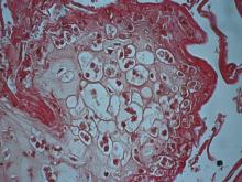 圖3：口唇部皮膚切片下可見細胞質內有疑似嗜酸性質內包涵體。