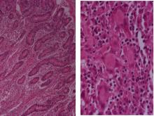 圖3A：腸管黏膜結構失去正常排列，可見到淋巴管擴張，上皮樣細胞，嗜酸性球及嗜中性球浸潤於間質組織。圖3B：腸黏膜於高倍下可見局部有多核巨細胞增生。 