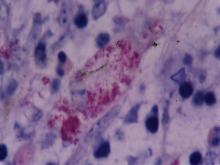 圖4：切片抗酸性染色於高倍下可見細胞質內有大量紫紅色短桿菌成堆聚集，於細胞間隙中亦可見成堆的紫紅色桿菌。