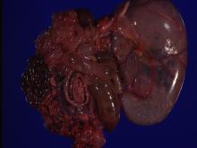 圖2：剖檢見第四胃充滿氣體及少量的內容物，大腸內也充滿氣體，局部小腸出血，腸淋巴結腫大。 