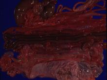 圖3：小腸可見空迴腸嚴重出血。