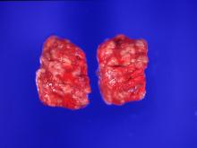 圖2：肺表面潮紅及多發局部大小不一黃白色結節。