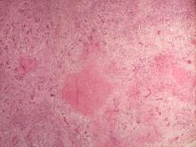 圖3：肺多發局部大小不一肉芽腫及多量巨大細胞浸潤。